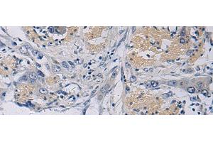 Immunohistochemistry of paraffin-embedded Human esophagus cancer tissue using KLF1 Polyclonal Antibody at dilution of 1:35(x200) (KLF1 antibody)