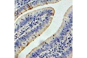 Immunohistochemical analysis of CCT3 staining in human colon cancer formalin fixed paraffin embedded tissue section. (CCT3 antibody)