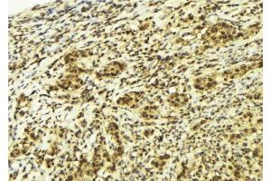 ABIN6277988 at 1/100 staining Human breast cancer tissue by IHC-P. (CTNNBL1 antibody  (N-Term))