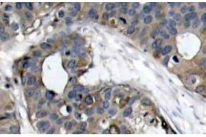 Immunohistochemistry (IHC) analyzes of HSP27 antibody in paraffin-embedded human breast carcinoma tissue. (HSP27 antibody)