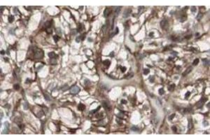 Immunohistochemistry of MAD2L2 polyclonal antibody  shows strong nuclear and cytoplasmic staining of tumor cells in cancerous human kidney tissue. (MAD2L2 antibody  (AA 3-14))