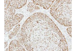 IHC-P Image Immunohistochemical analysis of paraffin-embedded Cal27 xenograft, using VDAC1, antibody at 1:500 dilution. (VDAC1 antibody)
