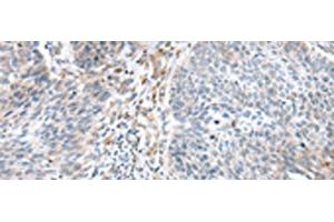 Immunohistochemistry of paraffin-embedded Human lung cancer tissue using WFDC5 Polyclonal Antibody at dilution of 1:60(x200)