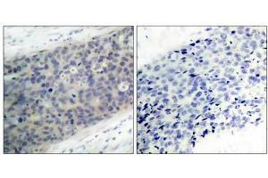 Immunohistochemical analysis of paraffin- embedded human breast carcinoma tissue using LIMK2 (phospho-Thr505) antibody (E011127). (LIMK2 antibody  (pThr505))