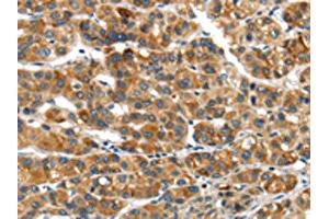 The image on the left is immunohistochemistry of paraffin-embedded Human liver cancer tissue using ABIN7192974(UBAP2 Antibody) at dilution 1/20, on the right is treated with synthetic peptide. (UBAP2 antibody)