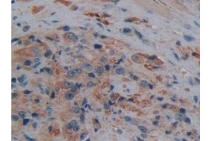 Detection of AQP1 in Human Prostate cancer Tissue using Polyclonal Antibody to Aquaporin 1 (AQP1) (Aquaporin 1 antibody  (AA 201-269))