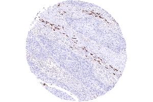 Squamous cell carcinoma containing many IgA positive plasma cells in its stroma (Recombinant Rabbit anti-Human IgA Antibody)