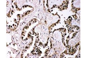 IHC-P: GSTP1 antibody testing of human lung cancer tissue (GSTP1 antibody  (AA 2-210))