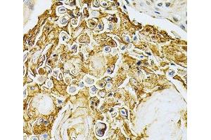 Immunohistochemistry of paraffin-embedded Human esophageal cancer using ADRBK1 Polyclonal Antibody at dilution of 1:200 (40x lens). (GRK2 antibody)