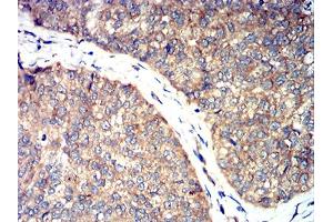 Immunohistochemical analysis of paraffin-embedded ROP1 tissues using bladder cancer mouse mAb with DAB staining. (ROP1 (AA 42-183) antibody)