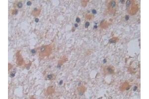 Detection of JAG2 in Human Glioma Tissue using Polyclonal Antibody to Jagged 2 Protein (JAG2) (JAG2 antibody  (AA 714-981))