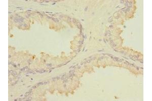 Immunohistochemistry of paraffin-embedded human prostate cancer using ABIN7159008 at dilution of 1:100 (MARCKSL1 antibody  (AA 1-195))