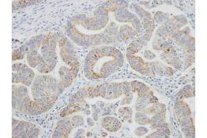 IHC-P Image Immunohistochemical analysis of paraffin-embedded human gastric cancer, using SRPR, antibody at 1:100 dilution. (SRPR antibody  (Center))