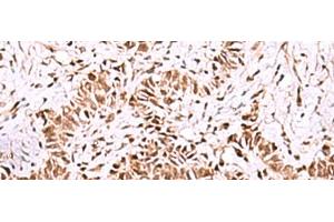 Immunohistochemistry of paraffin-embedded Human ovarian cancer tissue using ISY1-RAB43 Polyclonal Antibody at dilution of 1:55(x200)
