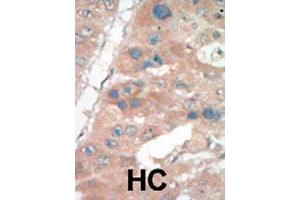 Formalin-fixed and paraffin-embedded human hepatocellular carcinoma tissue reacted with CDKN1A polyclonal antibody  , which was peroxidase-conjugated to the secondary antibody, followed by DAB staining. (p21 antibody  (C-Term))