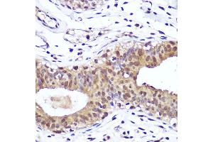 Immunohistochemistry of paraffin-embedded human breast cancer using [KO Validated] PTEN Rabbit mAb  at dilution of 1:100 (40x lens). (PTEN antibody)