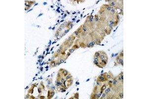 Immunohistochemical analysis of CHMP2B staining in human gastric cancer formalin fixed paraffin embedded tissue section. (CHMP2B antibody)