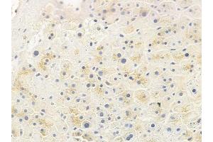 ABIN6259964 and ABIN6277220 at 1/100 staining human cervical carcinoma by IHC-P.