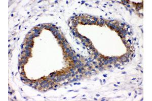 Anti- FUT1 Picoband antibody, IHC(P) IHC(P): Human Mammary Cancer Tissue (FUT1 antibody  (N-Term))