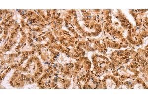 Immunohistochemistry of paraffin-embedded Human thyroid cancer tissue using HEXIM1 Polyclonal Antibody at dilution 1:65 (HEXIM1 antibody)