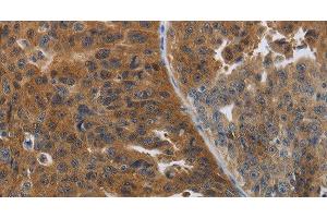 Immunohistochemistry of paraffin-embedded Human ovarian cancer tissue using PDCD2 Polyclonal Antibody at dilution 1:50 (PDCD2 antibody)