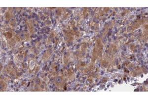 ABIN6277011 at 1/100 staining Human liver cancer tissue by IHC-P. (BMPR1B antibody  (N-Term))