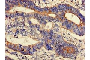 Immunohistochemistry of paraffin-embedded human colon cancer using ABIN7165956 at dilution of 1:100 (PPM1K antibody  (AA 30-372))