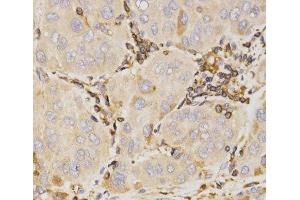 Immunohistochemistry of paraffin-embedded Human liver cancer using KLK5 Polyclonal Antibody at dilution of 1:200 (40x lens). (Kallikrein 5 antibody)