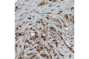 Immunohistochemical staining (Formalin-fixed paraffin-embedded sections) of human breast cancer with WWTR1 monoclonal antibody, clone CL0371  shows strong nuclear and moderate cytoplasmic immunoreactivity in tumor cells. (WWTR1 antibody)