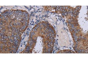 Immunohistochemistry of paraffin-embedded Human colon cancer tissue using NDUFA1 Polyclonal Antibody at dilution 1:30 (NDUFA1 antibody)