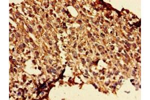 Immunohistochemistry of paraffin-embedded human melanoma using ABIN7154186 at dilution of 1:100 (GLRA1 antibody  (AA 23-113))