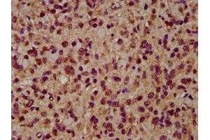 IHC image of ABIN7143995 diluted at 1:200 and staining in paraffin-embedded human glioma performed on a Leica BondTM system.