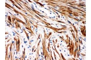 IHC-P: IkB beta antibody testing of human intestinal cancer tissue (NFKBIB antibody  (AA 56-237))