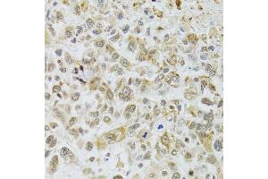 Immunohistochemistry of paraffin-embedded human lung cancer using DMAP1 antibody.