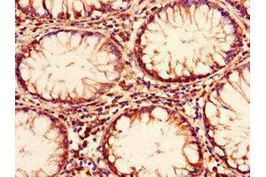 Immunohistochemistry of paraffin-embedded human colon cancer using ABIN7151381 at dilution of 1:100 (ENTPD8 antibody  (AA 30-434))