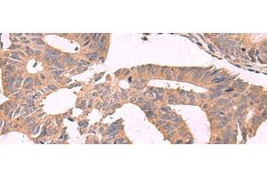 Immunohistochemistry of paraffin-embedded Human colorectal cancer tissue using MGP Polyclonal Antibody at dilution of 1:75(x200) (MGP antibody)