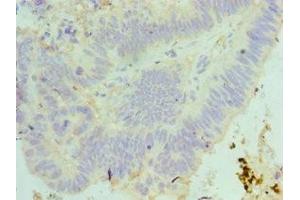 Immunohistochemistry of paraffin-embedded human colon cancer using ABIN7160089 at dilution of 1:100 (MAD2L1 antibody  (AA 1-205))