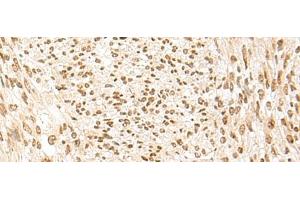 Immunohistochemistry of paraffin-embedded Human liver cancer tissue using POM121 Polyclonal Antibody at dilution of 1:75(x200) (POM121 antibody)