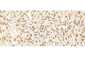 Immunohistochemistry of paraffin-embedded Human liver cancer tissue using POM121 Polyclonal Antibody at dilution of 1:75(x200)