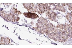 ABIN6273241 at 1/100 staining Human pancreas cancer tissue by IHC-P.