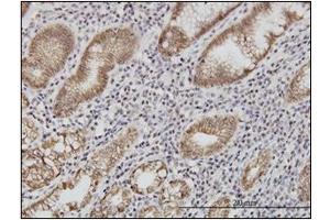 Immunohistochemistry (IHC) image for anti-Cadherin 1, Type 1, E-Cadherin (Epithelial) (CDH1) (AA 381-481) antibody (ABIN614587)