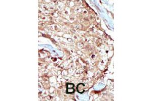 Formalin-fixed and paraffin-embedded human cancer tissue reacted with PAPSS2 polyclonal antibody  , which was peroxidase-conjugated to the secondary antibody, followed by AEC staining. (PAPSS2 antibody  (C-Term))