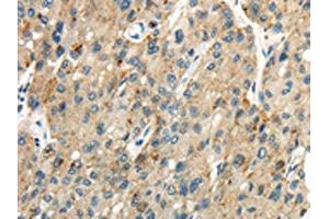 The image on the left is immunohistochemistry of paraffin-embedded Human liver cancer tissue using ABIN7190275(CLDN19 Antibody) at dilution 1/35, on the right is treated with synthetic peptide. (Claudin 19 antibody)