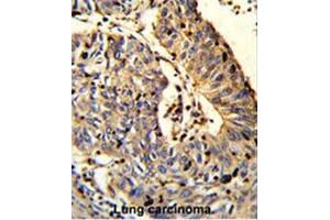 Formalin-fixed and paraffin-embedded human Lung carcinoma reacted with C21orf29 Antibody (Center), which was peroxidase-conjugated to the secondary antibody, followed by DAB staining. (TSPEAR antibody  (Middle Region))
