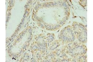 Immunohistochemistry of paraffin-embedded human breast cancer using ABIN7168731 at dilution of 1:100 (SCAMP4 antibody  (AA 170-228))