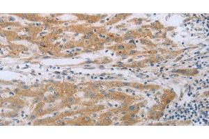 Immunohistochemistry of paraffin-embedded Human liver cancer using TNK2 Polyclonal Antibody at dilution of 1:70 (TNK2 antibody)