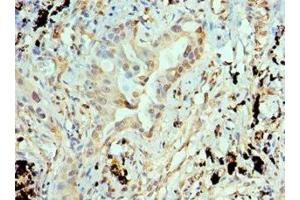 Immunohistochemistry of paraffin-embedded human lung cancer using ABIN7144325 at dilution of 1:100 (ANTXR1 antibody  (AA 315-564))