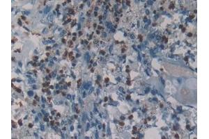 Detection of NE in Human Lung cancer Tissue using Polyclonal Antibody to Neutrophil Elastase (NE) (ELANE antibody  (AA 30-247))