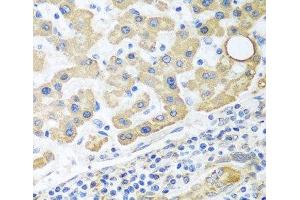 Immunohistochemistry of paraffin-embedded Human liver cancer using GLUD1 Polyclonal Antibody at dilution of 1:100 (40x lens). (GLUD1 antibody)