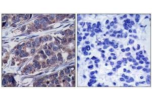 Immunohistochemical analysis of paraffin-embedded human breast carcinoma tissue using p62Dok(Phospho-Tyr362) Antibody(left) or the same antibody preincubated with blocking peptide(right). (DOK1 antibody  (pTyr362))